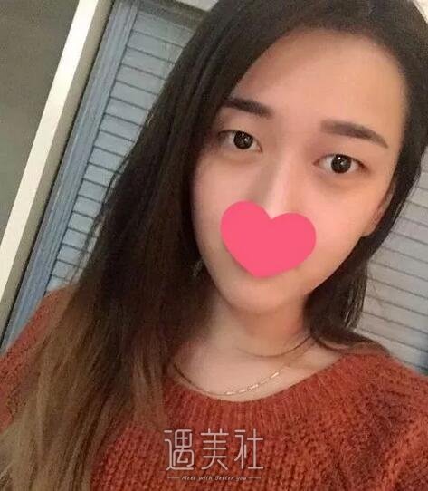 上海柴云双眼皮案例|上海柴云院长眼睛案例~