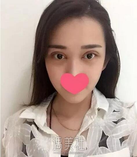 上海柴云双眼皮案例|上海柴云院长眼睛案例~
