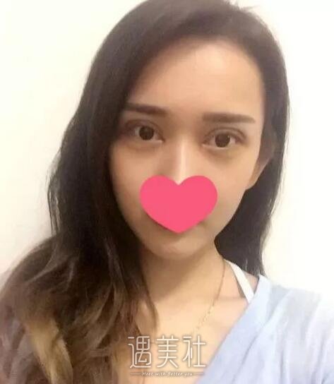 上海柴云双眼皮案例|上海柴云院长眼睛案例~