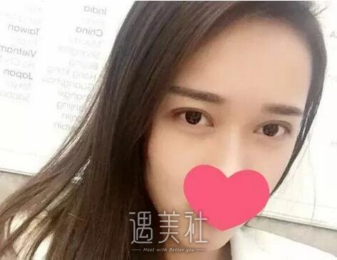 上海柴云双眼皮案例|上海柴云院长眼睛案例~