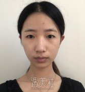 福州名韩李阳割双眼皮案例分享|其果靠谱吗? width=