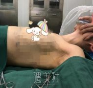郭震宇隆胸案例展示|谣言不攻自破！ width=