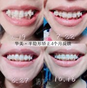 汕头华美牙齿矫正福利丨拍牙片&医生设计限时免费！ width=