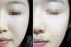 深圳联合丽格：提升力媲美埋线提升的玻尿酸，只能是乔雅登？ width=