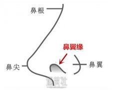 4.0鼻部手术丨鼻翼缘退缩该如何修复？薛志强为您解答！ width=