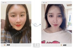 青岛伊美尔刘长发5s重睑术案例：术后恢复图片分享~ width=