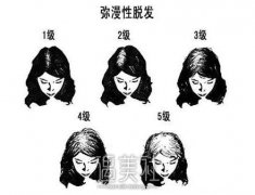 弥漫性脱发和雄脱有什么不同？该如何调节？ width=