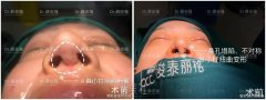 薛志强4.0鼻部手术丨鼻小柱疤痕如何修复？ width=