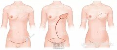 医生，我想用自己身上的组织再造乳房，能吗？ width=