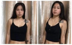 两年前做假体隆胸的人现在怎么样了？真实案例一览~ width=