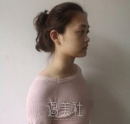 沈绍勇隆鼻案例展示｜看我惊人蜕变！ width=