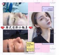 隆鼻手术还要做鼻尖成形？ width=