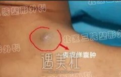 表皮样囊肿是怎么回事，严重吗？ width=