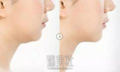 “饺子下巴”是什么鬼?如何做才能消除“饺子下巴” width=