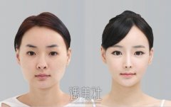 按摩VS注射 “缩脸功”方法大PK width=