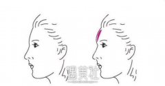 丰满额头打造术“饱满天庭”更显智慧 width=