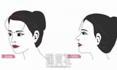 自体脂肪丰额头“天庭饱满” width=