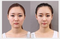 国字脸的悲哀 细数选择磨骨瘦脸后的那么点感受 width=