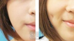 酒窝成形术 打造迷人小酒窝 width=