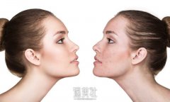 去下颌角瘦脸整形 美丽进化怦然心动 width=