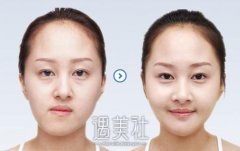 双下巴吸脂 给你优美颈部 width=