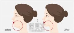 吸脂去双下巴 脸型悄然来 width=