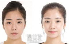 吸脂瘦脸 成就俏丽脸蛋与明星竞技 width=