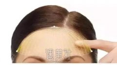 知道“C额头”吗?它的学名叫自体脂肪丰额头!  width=