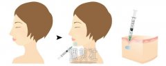 注射玻尿酸垫下巴后遗症严不严重 width=