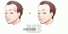 注射玻尿酸丰太阳穴 年轻自信乐开怀 width=