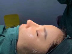 鼻梁低怎么办 隆鼻术打造秀挺美鼻 width=
