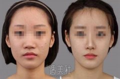 鼻子透光一定是做了假体隆鼻吗？ width=