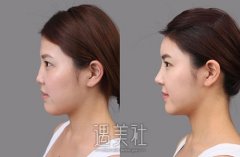 不适合做假体隆鼻的5类人 width=