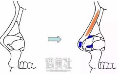 硅胶假体隆鼻后是不是会变歪? width=