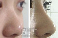 硅胶隆鼻能维持多久，有什么优势 width=