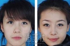 硅胶隆鼻是不是会透光? width=