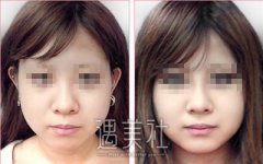 硅胶隆鼻术后感染怎么办? width=