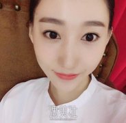 假体隆鼻 打造鼻型 width=