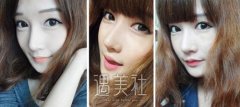 假体隆鼻感染的症状有哪些? width=