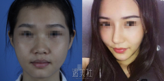 假体隆鼻后对嗅觉有影响吗? width=