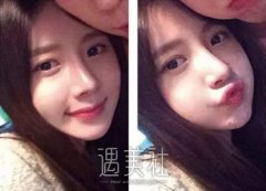 假体隆鼻后多久可以恢复?假体外露怎么办? width=