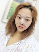 假体隆鼻术后会移动吗? width=