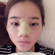 假体隆鼻果好吗? width=