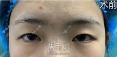 薛志强双眼皮案例 终于不像男的了 width=