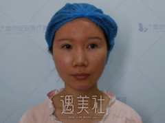 脂肪填充童颜双心脸果怎样？看一下手术前后的对比图~ width=