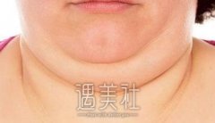 肿么可以快速去双下巴?去双下巴的方法有哪些? width=