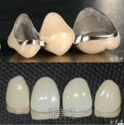 钯银合金烤瓷牙优缺点 width=