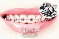 美国3M金属超薄托槽矫正牙齿的果好不好？ width=
