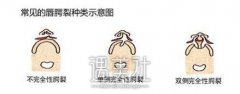 哪种情况的腭隐裂不用做手术？ width=