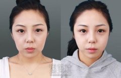 有法令纹怎么办?怎么调节有? width=